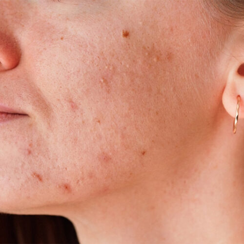 The Power of Peptides and Growth Factors: Revolutionizing Acne Treatment