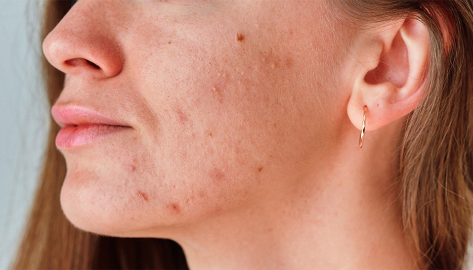 The Power of Peptides and Growth Factors: Revolutionizing Acne Treatment