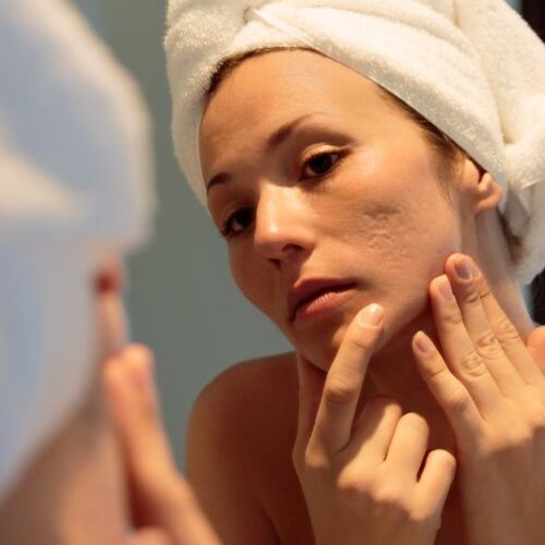 Med Spa Treatments for Acne Scars: Your Path to Clearer Skin