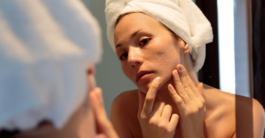 Med Spa Treatments for Acne Scars: Your Path to Clearer Skin