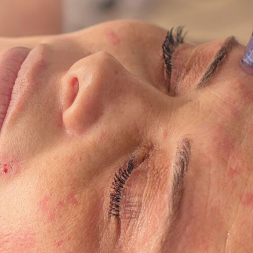 Micro-Needling: Unveiling the Skin Benefits of This Modern Treatment